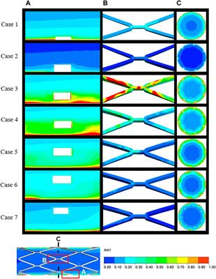 Computational simulation of stent thrombosis induced by various degrees of stent malapposition